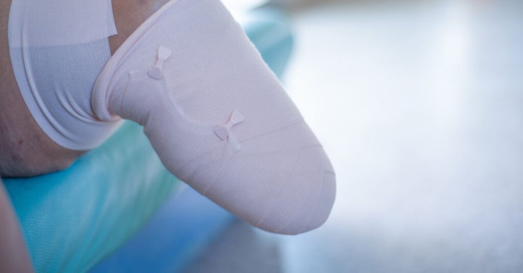 Zabezpieczony kikut po amputacji z opatrunkiem uciskowym wspierającym gojenie i ochronę skóry